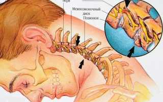 Лечение и последствия перелома шейного позвонка