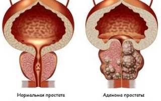 Как лечится аденома простаты при разных размерах опухоли?