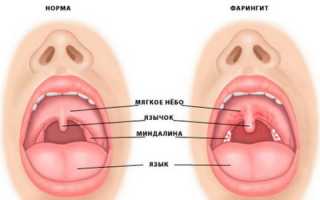 Диагностика и лечение катарального фарингита