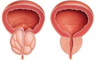 Причины и клинические проявления хронического простатита
