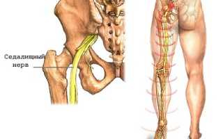 Ишиас  (воспаление седалищного нерва)