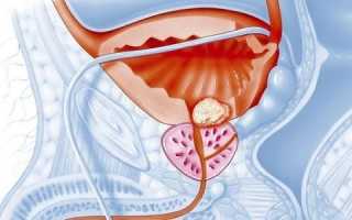 Может ли возникнуть простатит у женщин