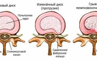 Все, что нужно знать о спинной грыже