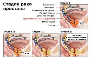 Способы лечения рака простаты содой: рецепты, противопоказания