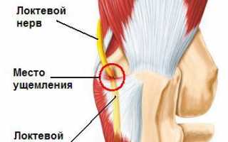 Защемление нерва в локтевом суставе