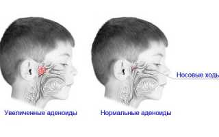 Что это воспаленные аденоиды?