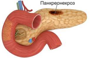 Как протекает геморрагический панкреонекроз?