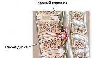 Лечение защемления нерва в пояснице