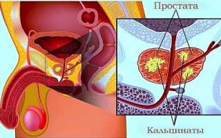 Симптомы острого и хронического простатита у мужчин