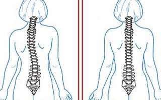 Причины сколиотической осанки у ребенка и взрослого