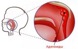 Как лечатся аденоиды у взрослых?