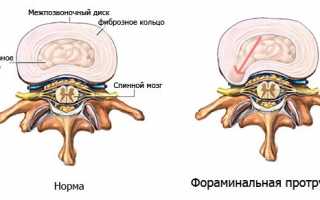 Лечение протрузии поясничного отдела позвоночника