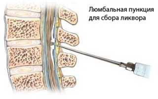 Опасна ли пункция спинного мозга?