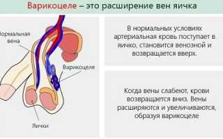 Степень влияния варикоцеле на потенцию