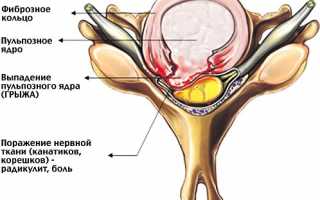Лечение грыжи грудного отдела позвоночника