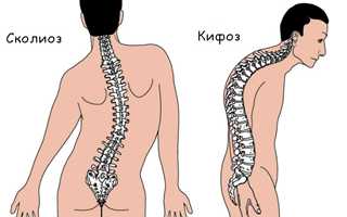 Всё о кифотической деформации (шейном кифозе)
