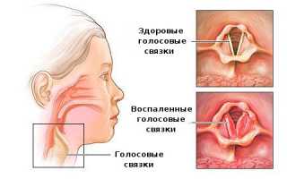 Какие необходимы ингаляции при ларингите?