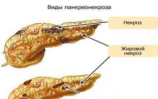 Опасен ли панкреатит?