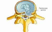 Симптомы и сложности заболевания протрузии диска L3-L4