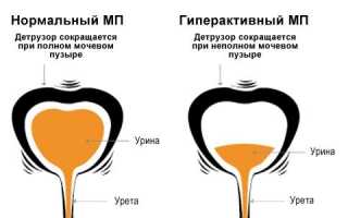 Профилактика и лечение гиперактивного мочевого пузыря