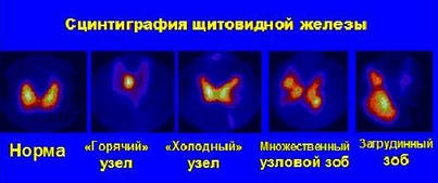 Результат сцинтиграфии щитовидки