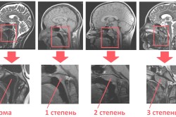 Аденоиды - степени увеличения