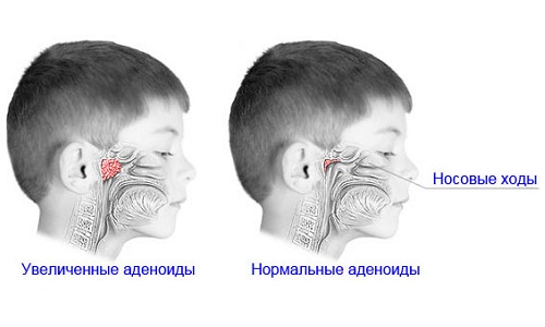 Увеличенные аденоиды