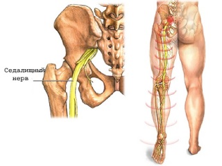 При ишиасе воспаляется седалищный нерв