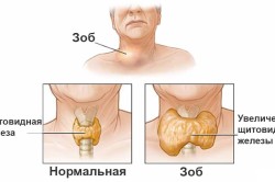 Пример увеличения щитовидки и формирования токсического узлового зоба