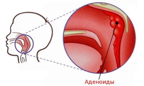 Расположение аденоидов