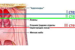 Степени аденоидов