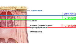 Степени аденоидного воспаления