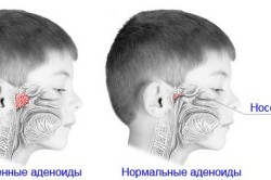 Сравнение здоровых и воспаленных аденоидов