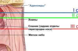 Степени увеличения аденоидов