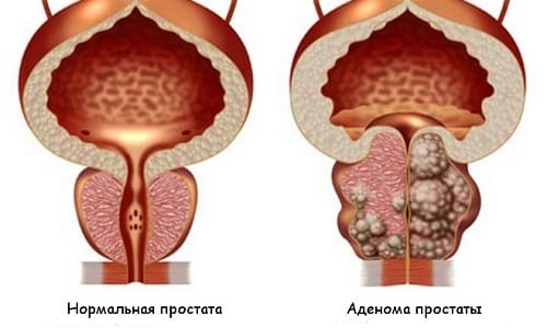 Аденома простаты - это заболевание мочеполовой системы, которому подвержены мужчины старше 45-55 лет