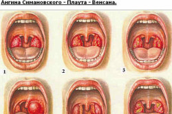 Виды острого тонзиллита (ангины)