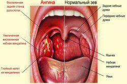 Схема ангины