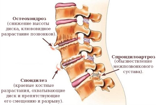 Заболевания позвоночника как причина боли в спине