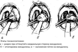 Этапы тонзиллэктамии