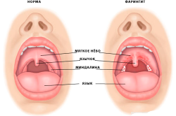 Проявление гранулезного фарингита