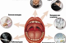 Причины заболевания фарингитом