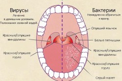 Симптомы фарингита