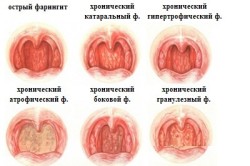 Формы фарингита