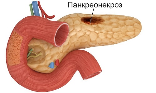 Геморрагический панкреонекроз - смертельно опасное патологическое состояние, характеризующееся полным или частичным разрушением тканей поджелудочной железы с возникновением кровоизлияний