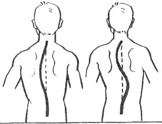 С-образный и S-образный сколиоз