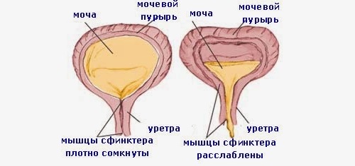 Схема гиперактивного мочевого пузыря