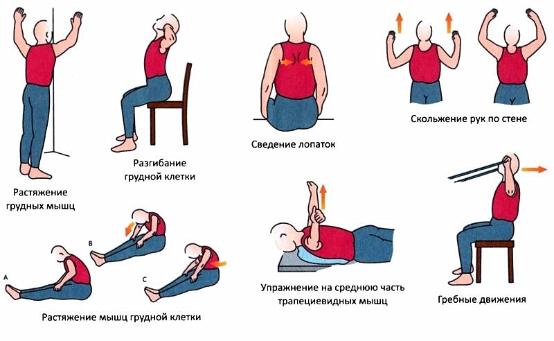 Упражнения при грудном радикулите