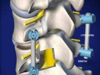 Фиксация поврежденных позвонков