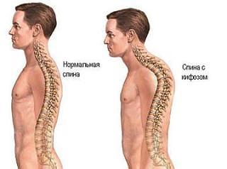 Кифоз классифицируют по углу изгиба позвоночника