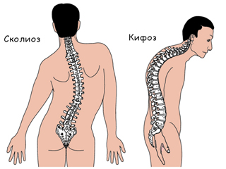 кифоз в шейном отделе позвоночника